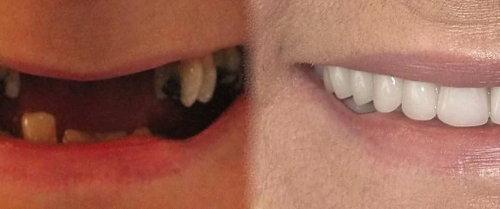All-on-4® Same Day Teeth: the patient's smile before treatment, left, and after, right