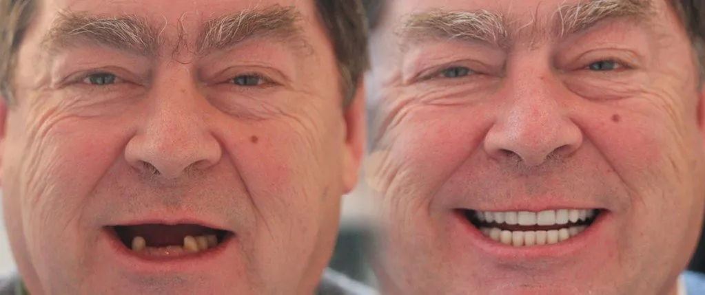 All-on-4® Same Day Teeth: the patient's smile before treatment, left, and after, right