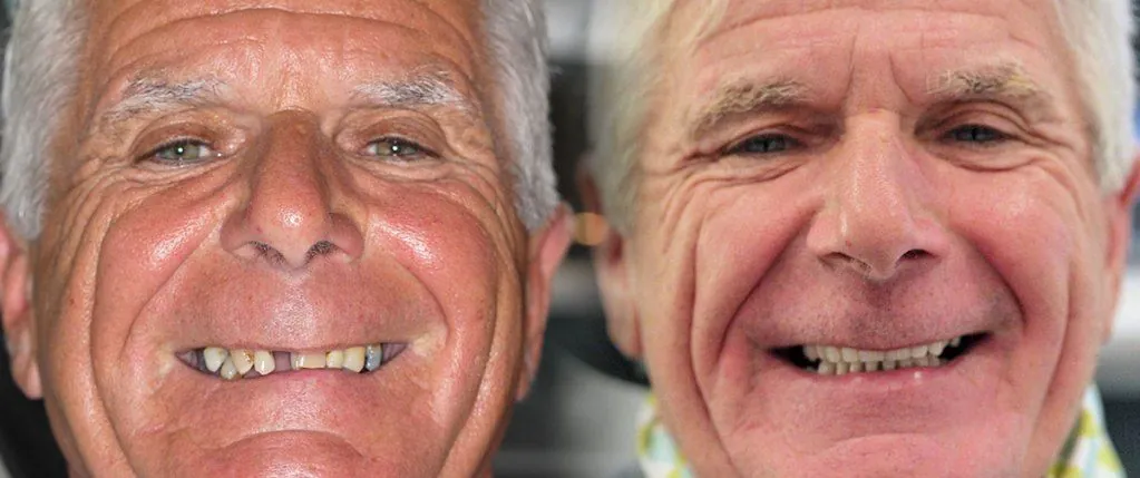 All-on-4® Same Day Teeth: the patient's smile before treatment, left, and after, right
