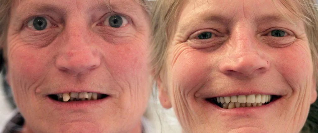 All-on-4® Same Day Teeth: the patient's smile before treatment, left, and after, right