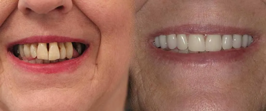 All-on-4® Same Day Teeth: the patient's smile before treatment, left, and after, right