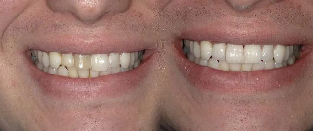 Composite Bonding: the patient's smile before treatment, left, and after, right