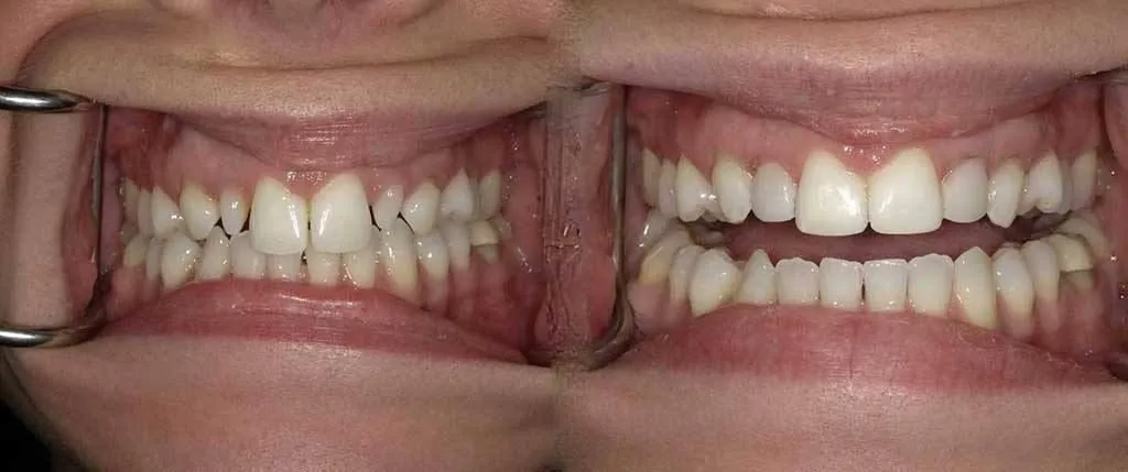 Composite Bonding: the patient's smile before treatment, left, and after, right