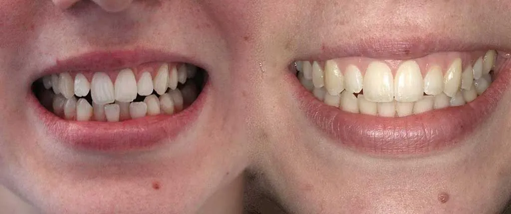 High-Speed Cosmetic Braces: the patient's smile before treatment, left, and after, right
