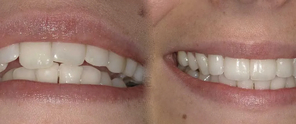 High-Speed Cosmetic Braces: the patient's smile before treatment, left, and after, right