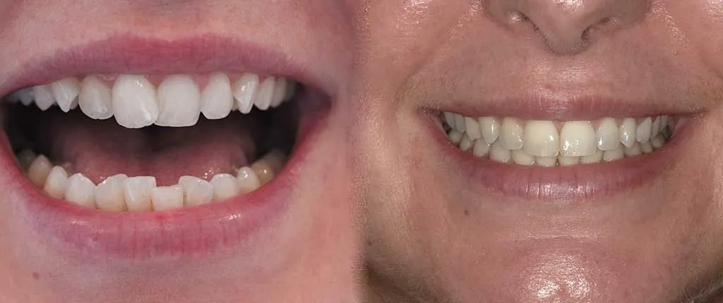 High-Speed Cosmetic Braces: the patient's smile before treatment, left, and after, right