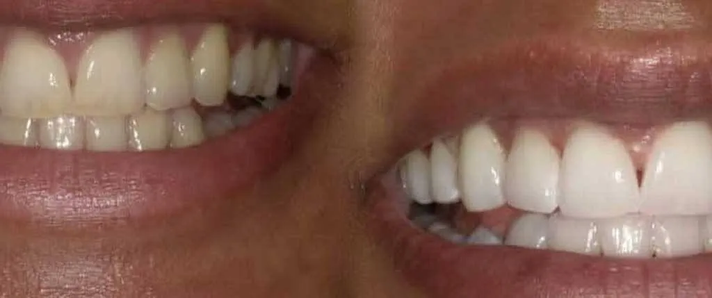 Teeth Whitening: the patient's smile before treatment, left, and after, right